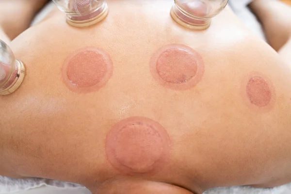 Wet cupping marks and cuts on patient after hijama treatment.