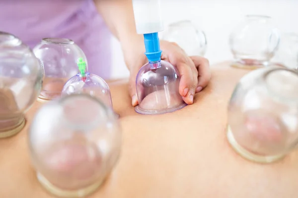 Close up view of vacuum cups filled during hijama cupping therapy.