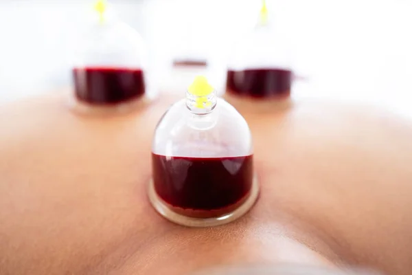 Vista Cerca Vasos Vacío Llenos Sangre Durante Terapia Ventosas Hijama — Foto de Stock