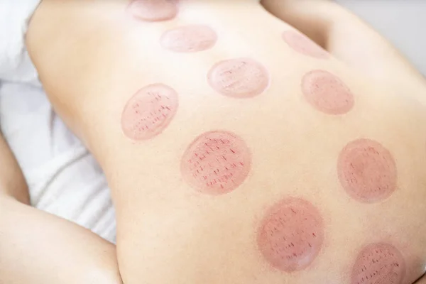 Wet cupping marks and cuts on patient after hijama treatment.