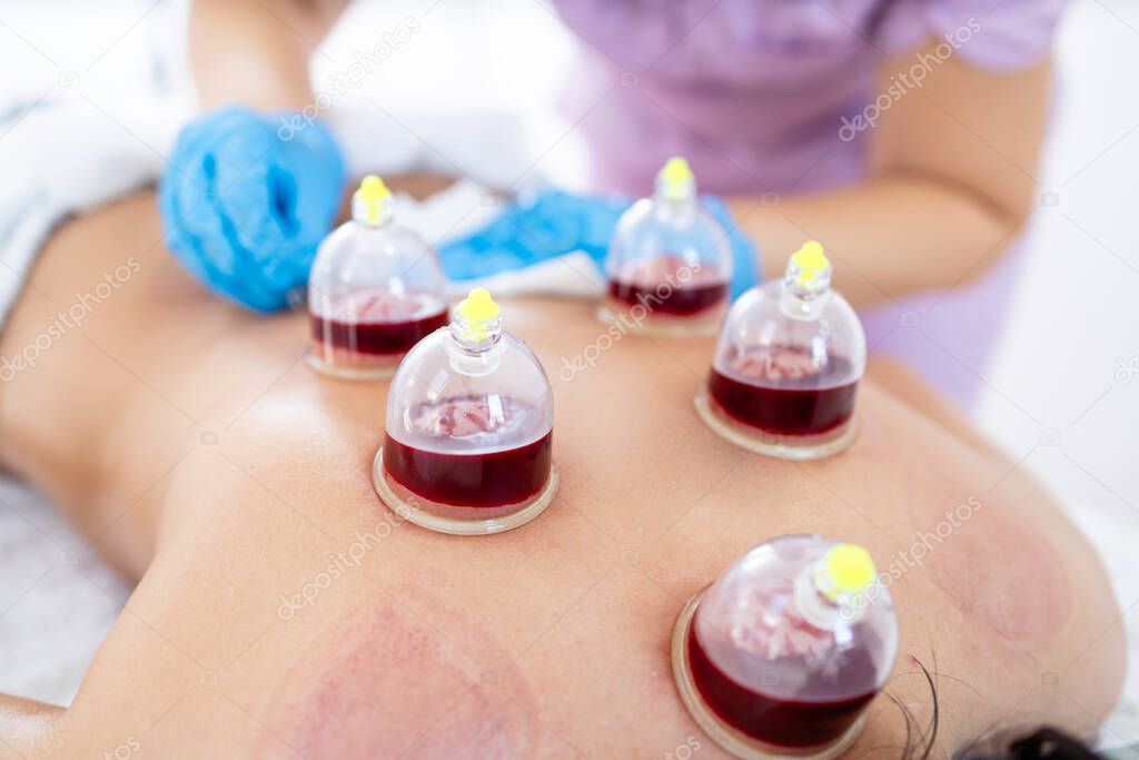 Tratamiento Hijama Húmedo Con Ventosas Sangrado Realizado Espalda