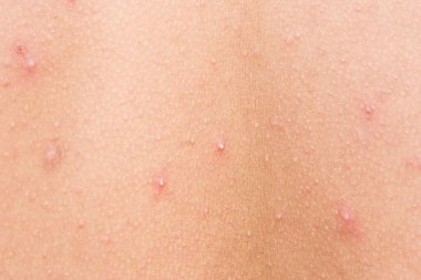 Üst sırtı fotokopi aletiyle kaplayan abult hastası bir kadın.