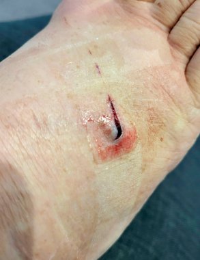 Stingray kırbaç yarası ayağında kesiğe neden olmuş. Yaranın temizlenmesi ve tıbbi yıkanması gerekiyor. Bu deniz hayvanları iğnelerini kurbanlarına zehir enjekte etmek için kullanıyorlar..