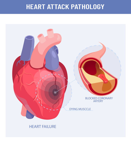 Медицинская иллюстрация сердечного приступа и атеросклероза. Вектор поврежденного сердца, поперечное сечение коронарной артерии с атеросклеротической бляшкой 