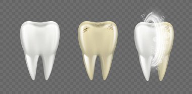 Kökleri, diş bakımı ve diş koruması olan kirli ve temiz gerçekçi dişler. Vektör beyazlatma ve hijyenik temizlik bakteri ve sarılığı azaltıyor. Klinikte tıp ve sağlık