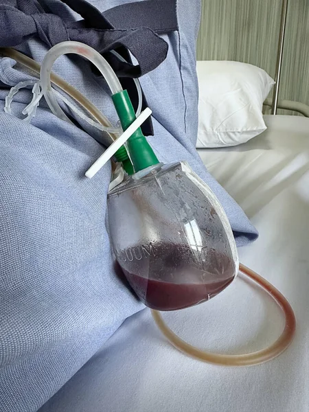 Vákuum Blood Draining Pot Cső Után Thyroidectomia — Stock Fotó