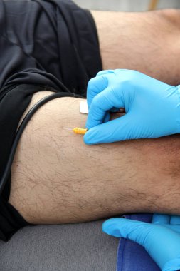 Electromyography EMG and Somatosensory Evoked Potential PEV of lower extremities, neurophysiological test applies electrical stimuli near the nerves to explore the rectus femoris muscle