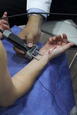 Karpal tünel sendromu, çevresel nöropati veya sinir hasarı teşhisi koymak için kadın bir hastanın elinde ve kolunda elektromiyografi ve Somatosensoryal PESS var.