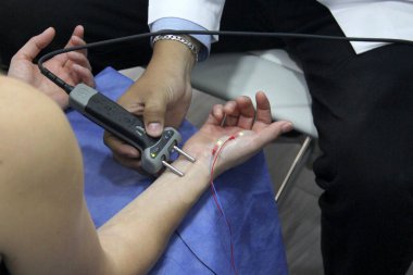 Karpal tünel sendromu, çevresel nöropati veya sinir hasarı teşhisi koymak için kadın bir hastanın elinde ve kolunda elektromiyografi ve Somatosensoryal PESS var.