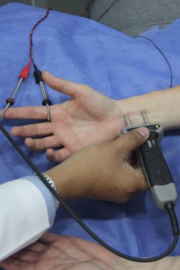 Karpal tünel sendromu, çevresel nöropati veya sinir hasarı teşhisi koymak için kadın bir hastanın elinde ve kolunda elektromiyografi ve Somatosensoryal PESS var.