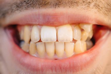 man showing crooked growing teeth. The man needs to go to the dentist to install braces.