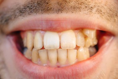 Çarpık dişleri yakından çek.