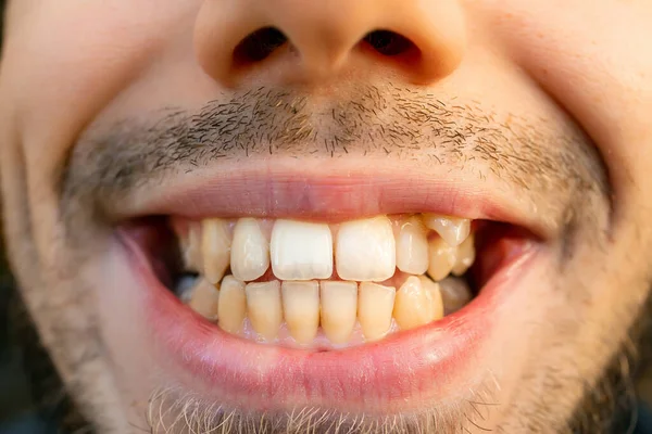 Close Young Man Face Crooked Teeth Teeth Install Braces Need — Fotografia de Stock