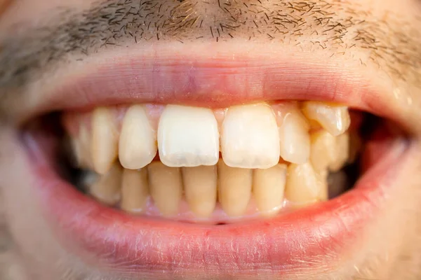 Close Man Face Crooked Teeth Install Braces Teeth Need Ortodontic — Fotografia de Stock