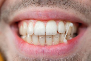 Young man use orthodontic rubber band on his teeth to correct his bite. Dental concept.