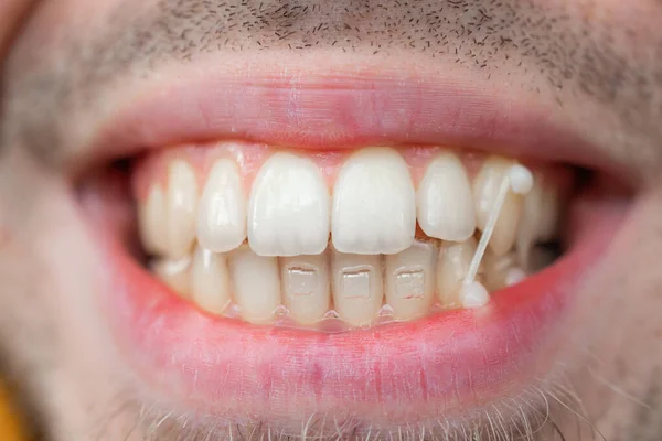 Jongeman Gebruikt Orthodontische Elastiekjes Zijn Tanden Zijn Beet Corrigeren Tandheelkundig — Stockfoto