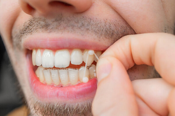 Close-up of man wearing orthodontic elastic band
