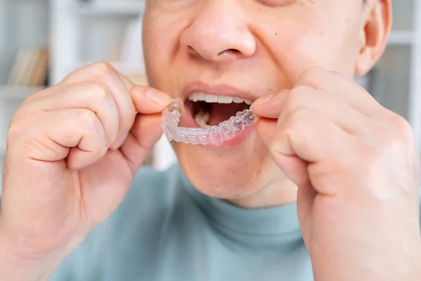 正畸硅胶透明牙齿的特写在男性的手上 用于牙齿美白的支架 剪下来的照片 — 图库照片