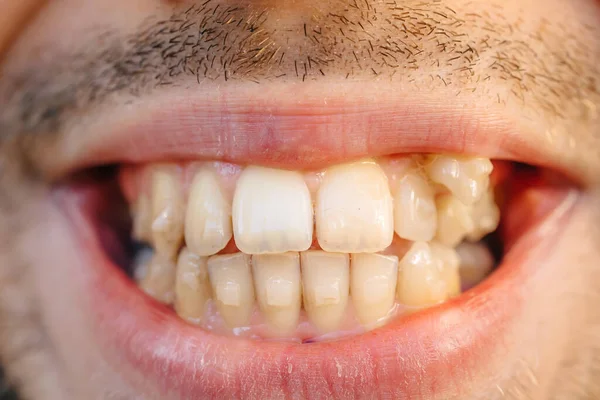 Gebogen Mannelijke Tanden Voor Het Installeren Van Beugels Close Van — Stockfoto