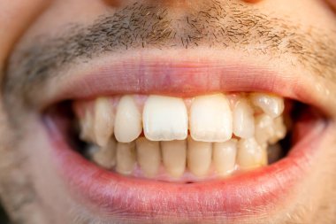 Çarpık dişli genç adamın yüzünü kapatın. Diş teli takmadan önce dişler. Dişlerin ortodonti 'ye ihtiyacı var.