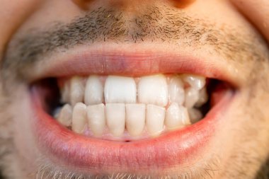 Çarpık dişler yakın plan. Diş sorunları, diş bakımı. Orta yaşlı bir adamın doğal dişleri..