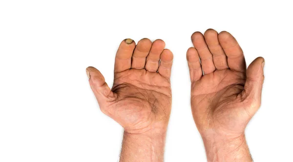 Тріснута Зруйнована Шкіра Перевантажених Чоловічих Пенсіонерських Руках Білому — стокове фото