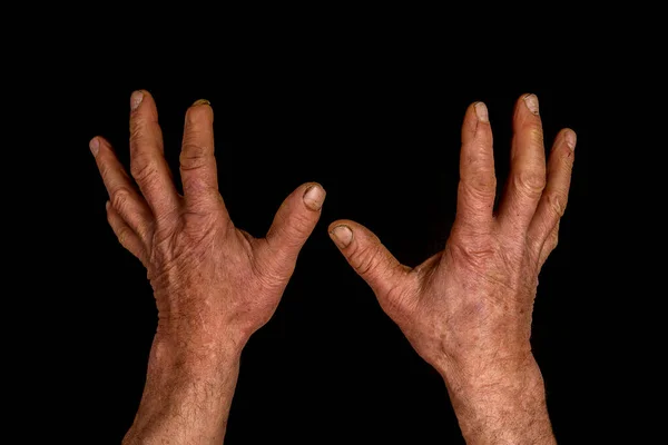 Тріснута Зруйнована Шкіра Перевантажених Чоловічих Пенсіонерських Руках Чорному — стокове фото