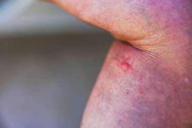 Bacağındaki tahriş olmuş deriyi şişmiş kırmızı sivrisinek ısırığı ve böcek sokmasından sonra görülebilir alerjik reaksiyon ile kapatın. Punta Cana. Dominik Cumhuriyeti.