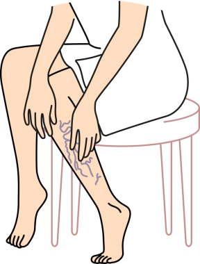 Kadın varisli bacaklara dokunuyor.