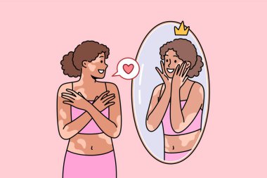 Vitiligo sendromu olan ya da cildinde lekeler olan bir kadın aynaya bakar ve gülümser, kendini olduğu gibi kabul eder. Yüksek özsaygısı ve vitiligo hastalığı olan etnik bir kız kendi yansımasına sempati duyuyor.