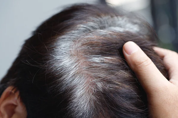 stock image Back view of young people premature gray hair, showing black hoary hair roots on head change to senior old man outdoor.