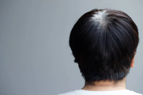 Вид Ззаду Молодих Людей Передчасне Сіре Волосся Показує Чорні Коріння — стокове фото