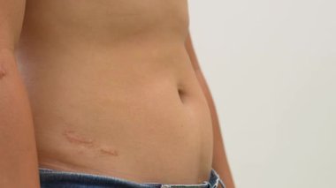 Koca göbekli ve aşırı yağlı obez adam diyetlerini kontrol etmeli..