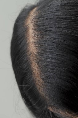 Saç dökülmüş, kuru ve kıvırcık saçlı bir kadın.