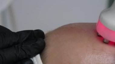 Tanımlanamayan kadın alnına güzellik salonunda ultrason uygulanır. Deri yenileme terapisi. Kozmetik dermatoloji RF kaldırma prosedürü karmaşık, yakın plan