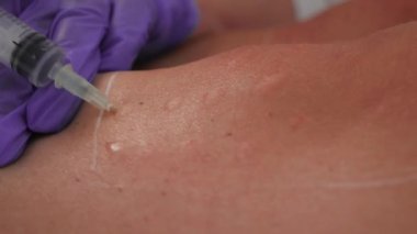 Dizlerindeki estetik prosedür, profesyonelce yapılan şırıngayla kırışıklık giderilmesi, yakın çekim. Kozmetik kliniğinde bacaklardan yağ alma prosedürü