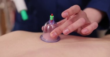 Masaj süpürgesi bardakları. Spa salonunda sırtüstü uzanmış kadınlar. Tedavi ve kozmetolojide vakum kavanozları. Süpürge terapisi. Bardak masajı.