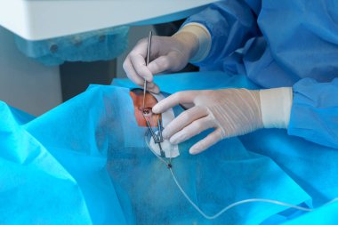 Cerrahın elleri, steril bir ortamda hassasiyet ve hijyen sağlamak için özel aletlerle kusursuz bir göz ameliyatı yapıyor.