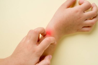 Kızın kolundaki böcek ısırığı alışmaya ve kaşınmaya başladı.