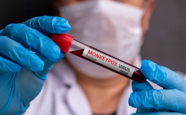 Tıbbi eldiven giyen doktor elinde maymun çiçeği virüsü taşıyan bir kan tüpü tutuyor..