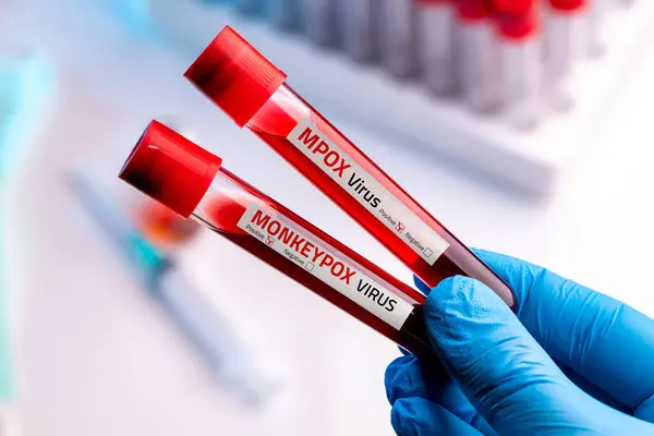 stock image Doctor wearing medical gloves holding a blood tube with positive Monkeypox - Mpox virus Blood Sample.