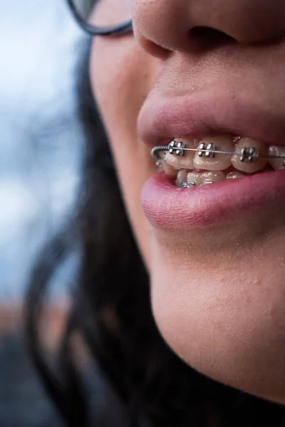 stock image Girl with braces smiling in summer