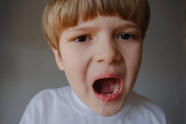 Closeup Portrait Kid Showing His Teeth Cavities Problem —  Fotos de Stock