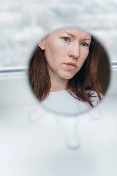 White Woman Acne Looks Mirror — Fotografia de Stock