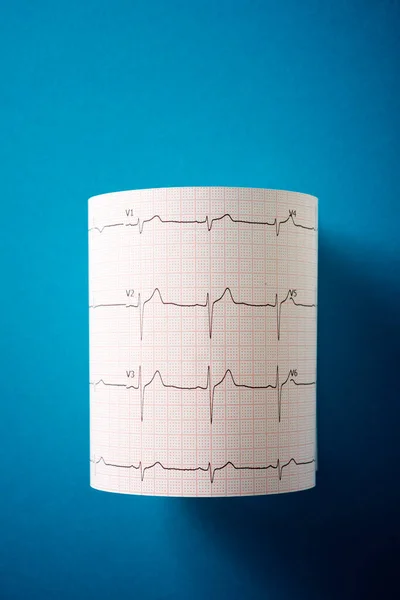 Eletrocardiograma Impresso Papel Sobre Mesa Azul — Fotografia de Stock