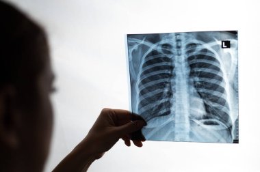 Doktor hastaların akciğerlerinin röntgenini gösteriyor.