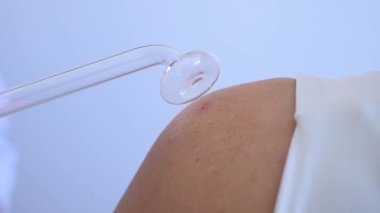Doktor, kadın bir hastanın omzundaki sivilcelere karşı darsonval aparatı kullanıyor.
