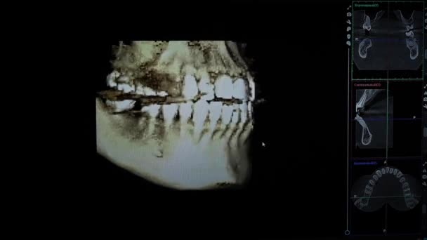 Model Rentgenového Snímku Lidské Čelisti Počítačový Program Pro Zubní Zobrazování — Stock video