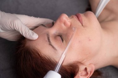 Doktor, kadın bir hastanın yüzündeki sivilce için darsonval aparatı kullanıyor.