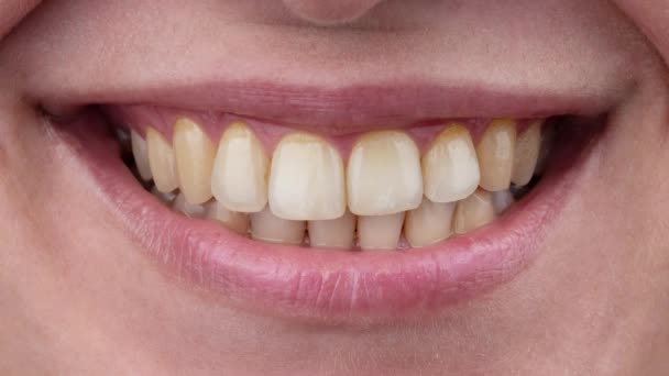 Close Sorriso Mulheres Antes Depois Clareamento Dos Dentes — Vídeo de Stock